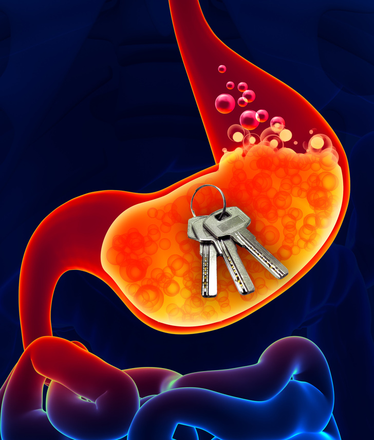 Stomach acid can dissolve metal.