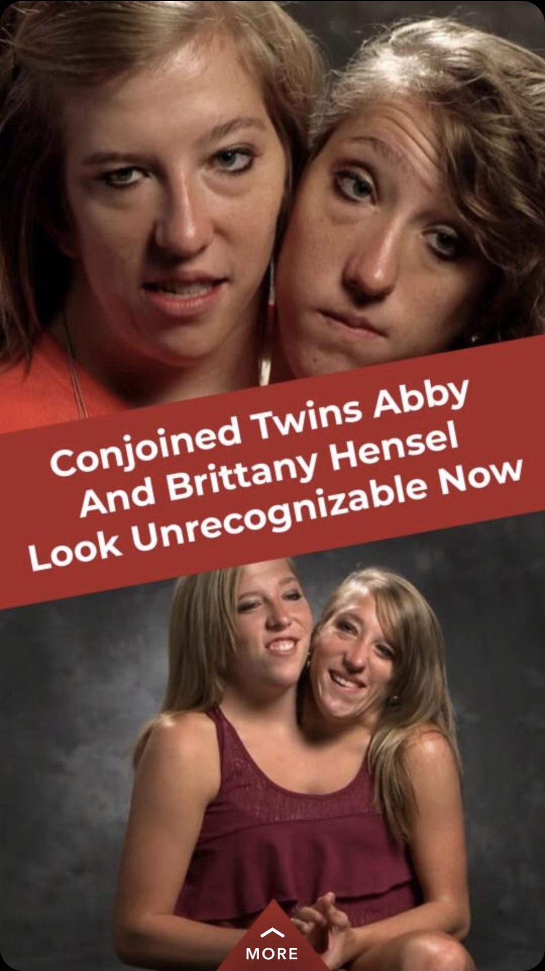 conjoined twins famous - Conjoined Twins Abby And Brittany Hensel Look Unrecognizable Now More