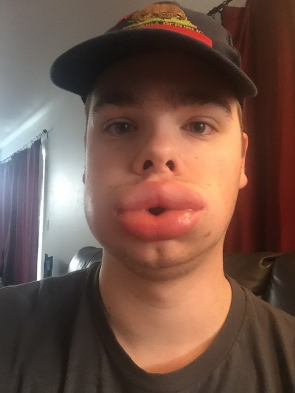 allergic reaction swelling