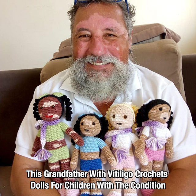 joão stanganelli - This Grandfather With Vitiligo Crochets Dolls For Children With The Condition