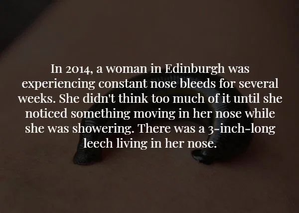 photo caption - In 2014, a woman in Edinburgh was experiencing constant nose bleeds for several weeks. She didn't think too much of it until she noticed something moving in her nose while she was showering. There was a 3inchlong leech living in her nose.