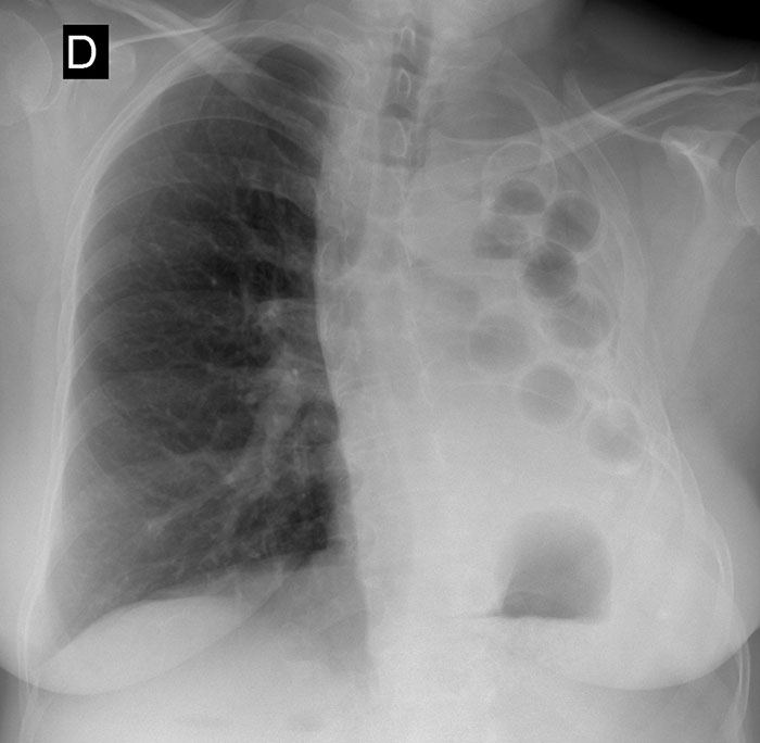 Prior to the introduction of effective tuberculosis medicine, plombage was used to treat the disease from the 1930s to the 1950s. Physicians believed that a collapsed lung would heal faster, so they used the plombage method to forcibly collapse the lung. During the procedure, a doctor would create a cavity underneath the upper ribs and fill the space with materials such as Lucite (acrylic) balls, ping pong balls, oils, rubber sheets, paraffin wax, or gauze. Unsurprisingly, this treatment carried the risk of complications. Many of the patients suffered from hemorrhage, infection, and fistulization (abnormal opening between two hollow organs) of the bronchus, aorta, esophagus, and skin.