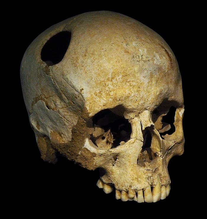 Trepanation, the practice of drilling, cutting or scraping holes in a person's skull, has been around since prehistoric times. It is believed to be one of the oldest surgical procedures—however, scientists are unsure why our ancestors performed it. In western medicine, up until the 19th century, trepanation was widely used to treat head traumas.