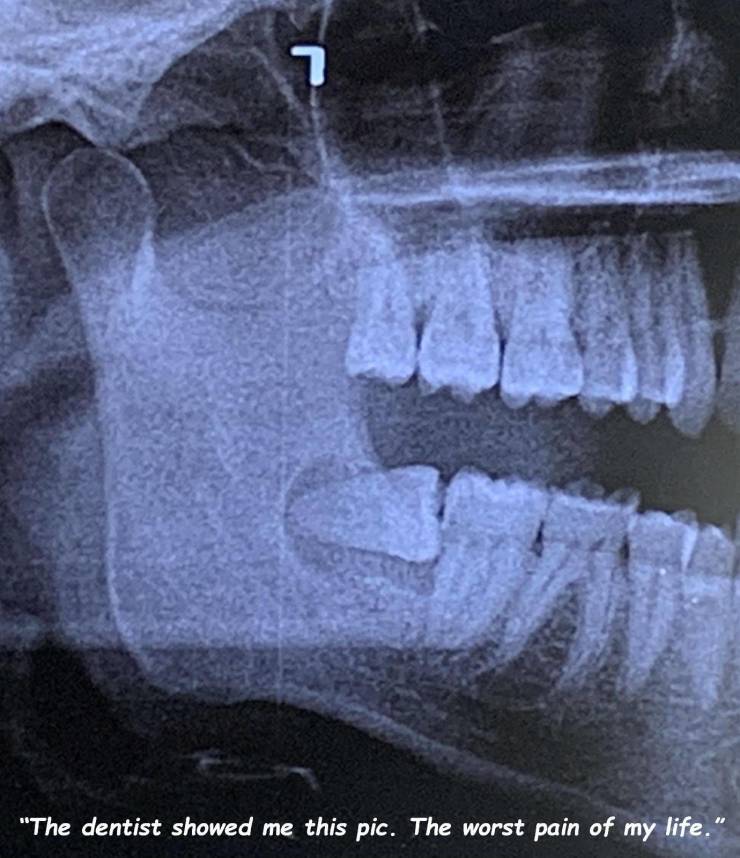 Photograph - "The dentist showed me this pic. The worst pain of my life."