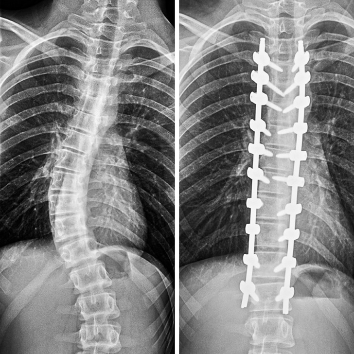 scoliosis surgery x ray