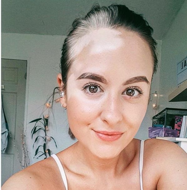 “Finally embracing my vitiligo and white streak after 16 years of trying to hide it.”