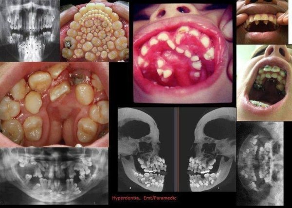 teeth in top of mouth - Hyperdontia. EmtParamedic