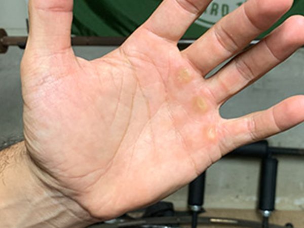 hand calluses