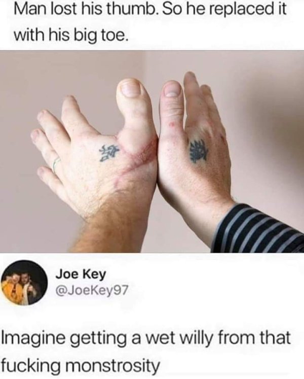 toe thumb replacement - Man lost his thumb. So he replaced it with his big toe. Joe Key Imagine getting a wet willy from that fucking monstrosity