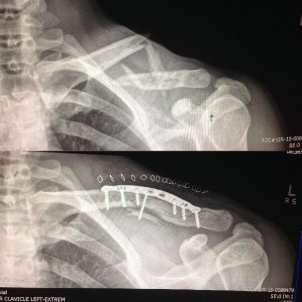 collar bone broken before and after - Acc Sed vo30 ODD0000000 000 Dodo kial R Clavicle LeftExtrem Accesr150098479 SeO Im1