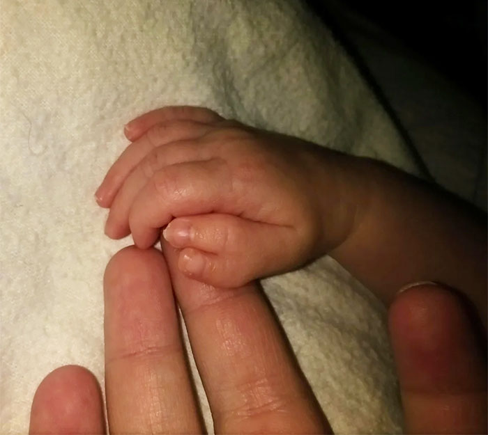 My Daughter Was Born Polydactyl On One Hand With Two Thumbs.