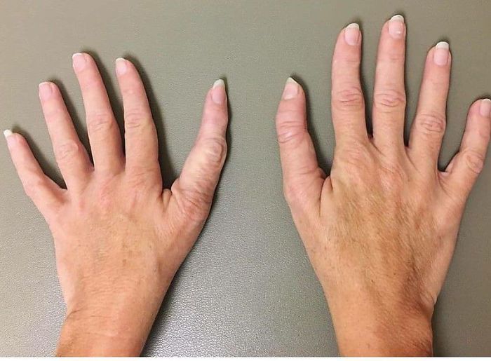 This Person Has A Thumb With Three Phalanges Instead Of Two