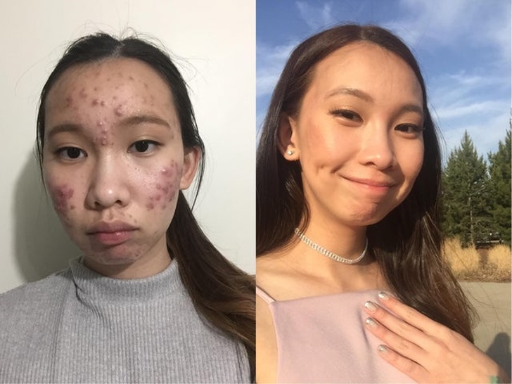 accutane 5 month course - woman before and after photos with and without acne