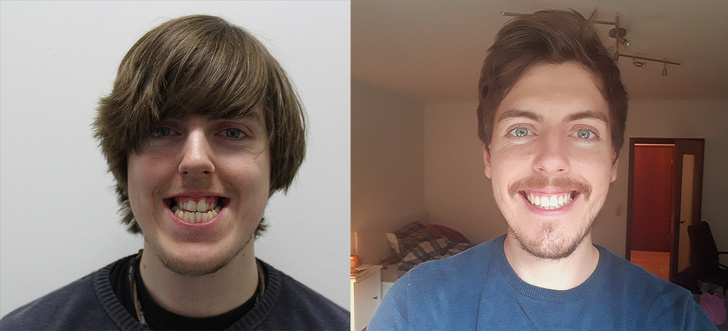 crooked jaw reddit - man before and after crooked teeth jaw surgery