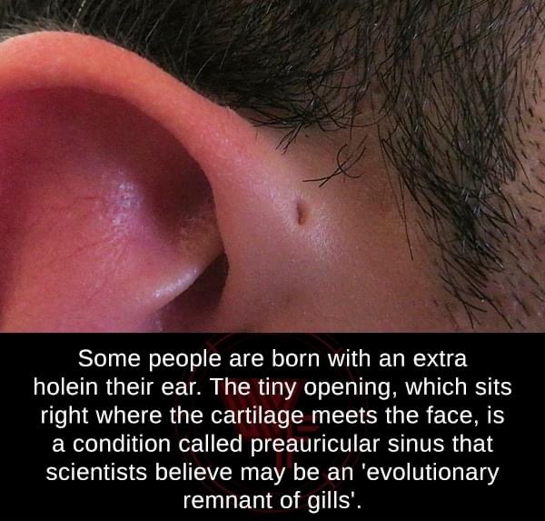 ear - Some people are born with an extra holein their ear. The tiny opening, which sits right where the cartilage meets the face, is a condition called preauricular sinus that scientists believe may be an 'evolutionary remnant of gills'.