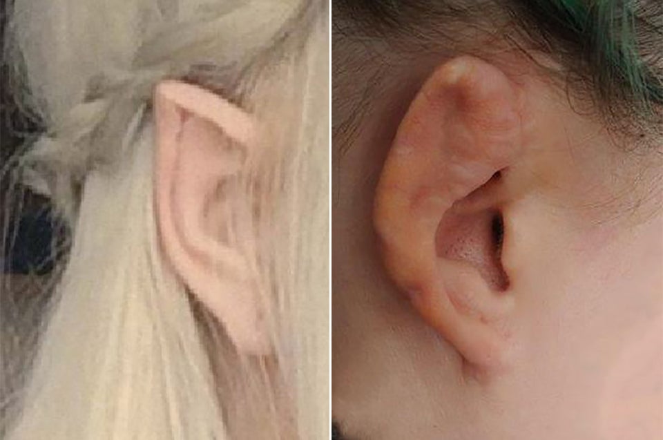 pixie ears surgery