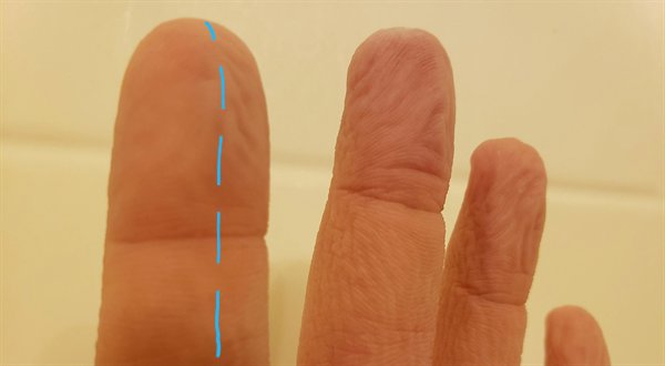 human hand showing half of one finger not wrinkling after becoming wet