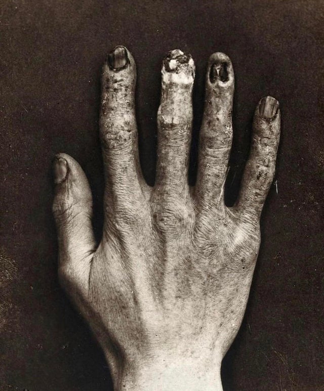 hand radiation exposure