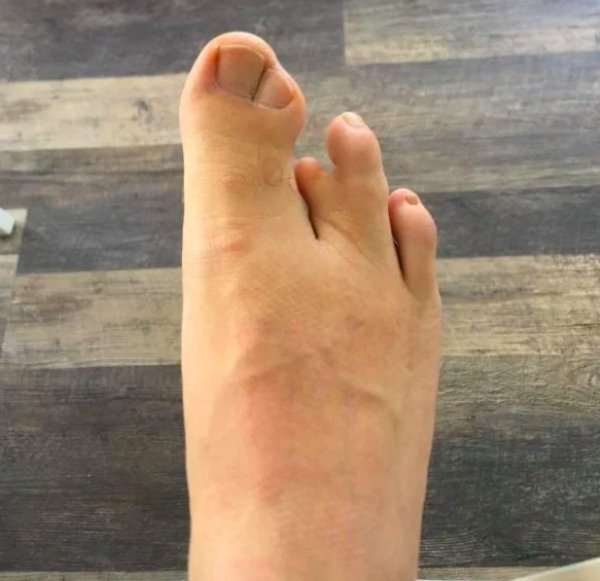 Three-ish connected toes