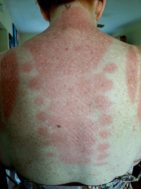 sunburn on back in unfortunate pattern