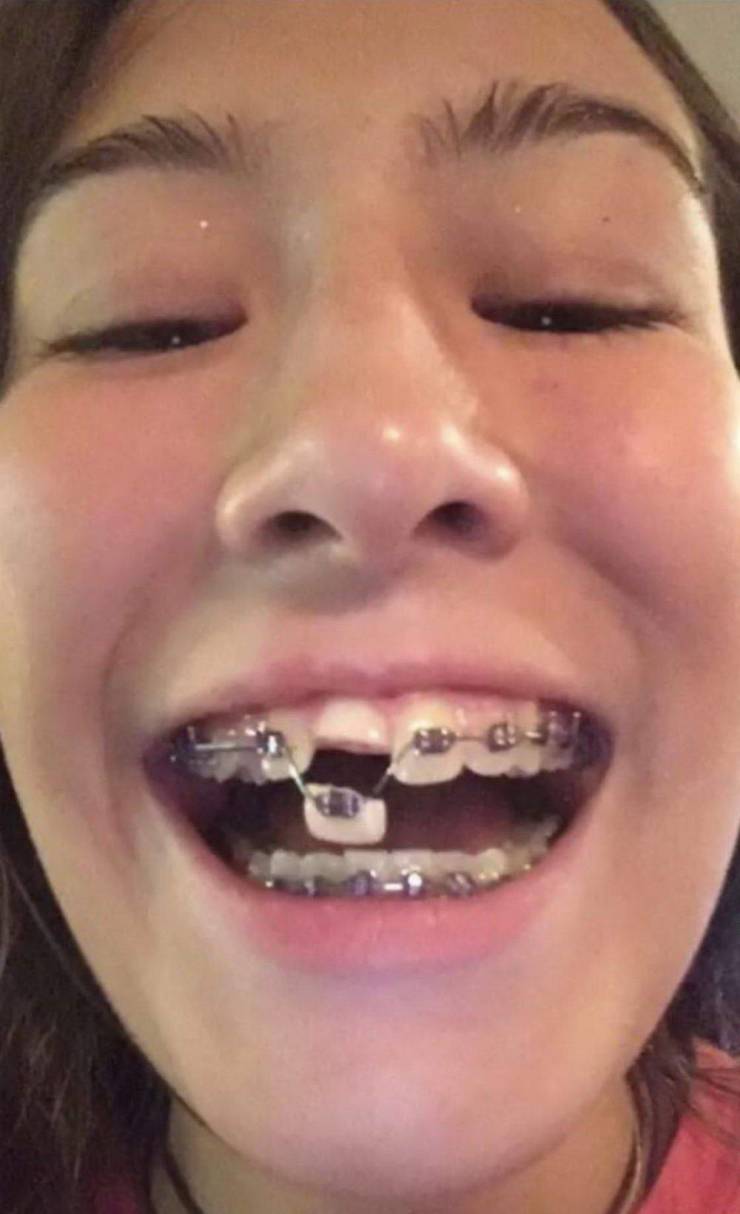 girl with braces breaks a tooth
