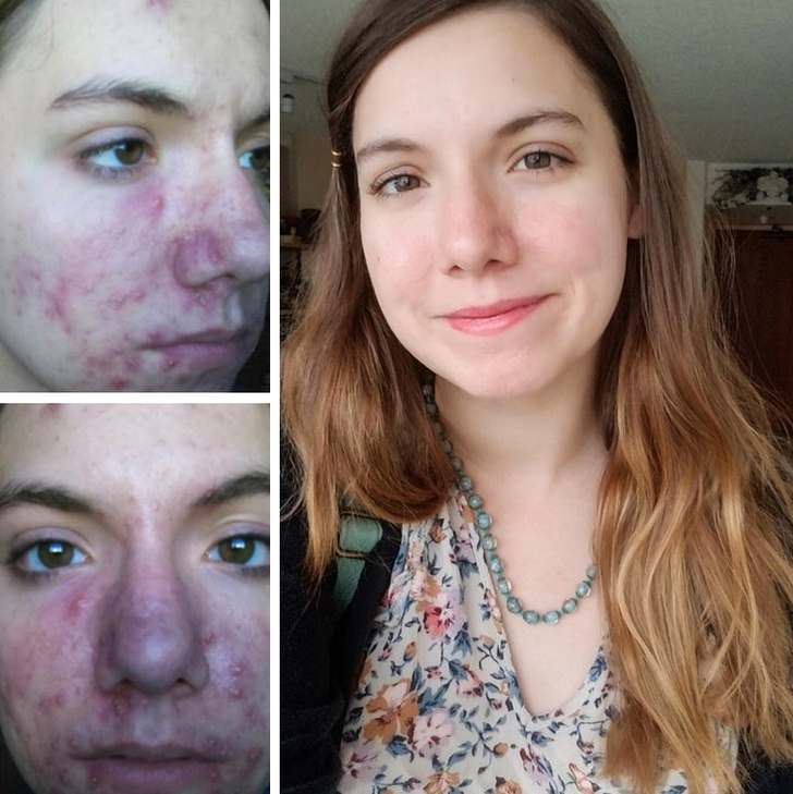 “Finally healed! So ready to start the next phase of my life and put the last decade of acne behind me.”
