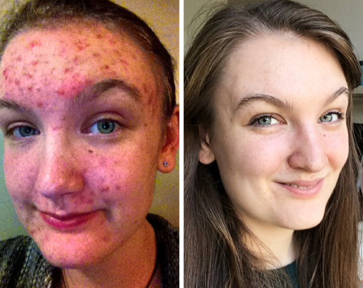 “Lost my acne and gained some confidence!”