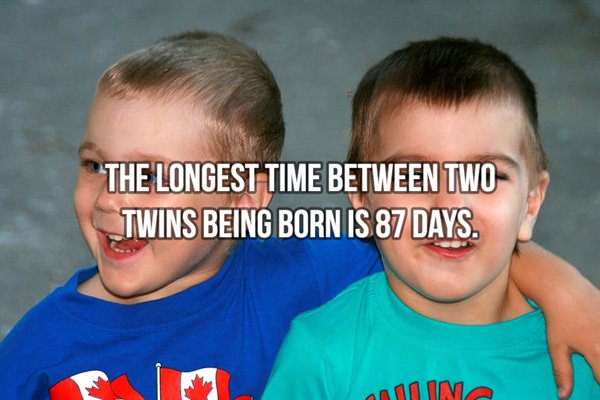 "The Longest Time Between Two Twins Being Born Is 87 Days.