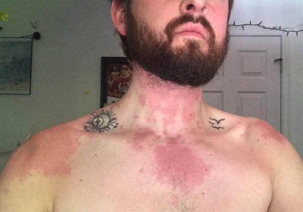 guy becomes allergic to alcohol