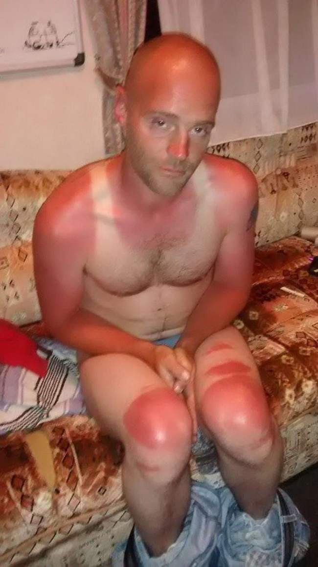 bald guy got sun burned all over his body