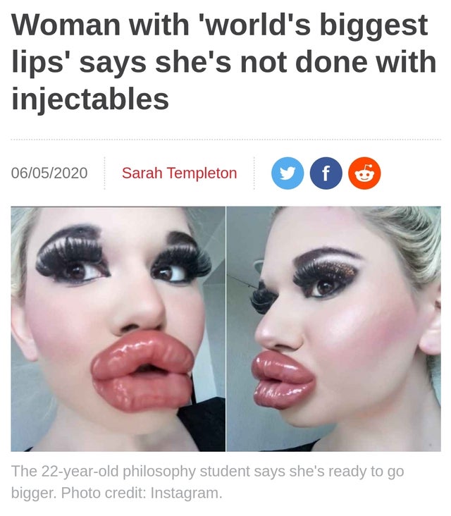 lip - Woman with 'world's biggest lips' says she's not done with injectables 06052020 06052020 Sarah Templeton Sarah Templeton The 22yearold philosophy student says she's ready to go bigger. Photo credit Instagram.