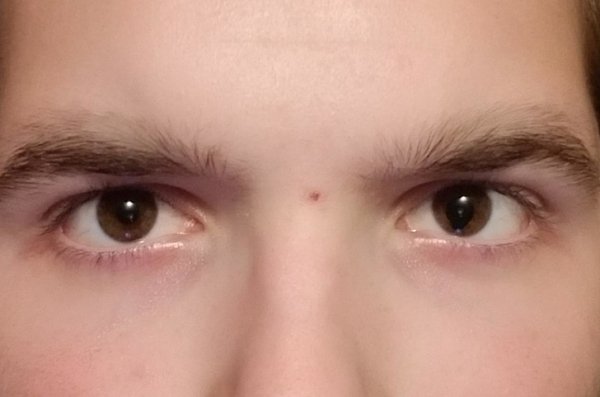 One of my eyes has a colobolma (on the right side of the picture).