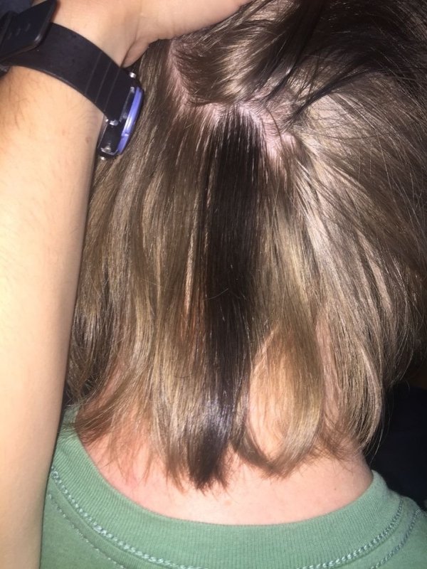 blonde patch in hair