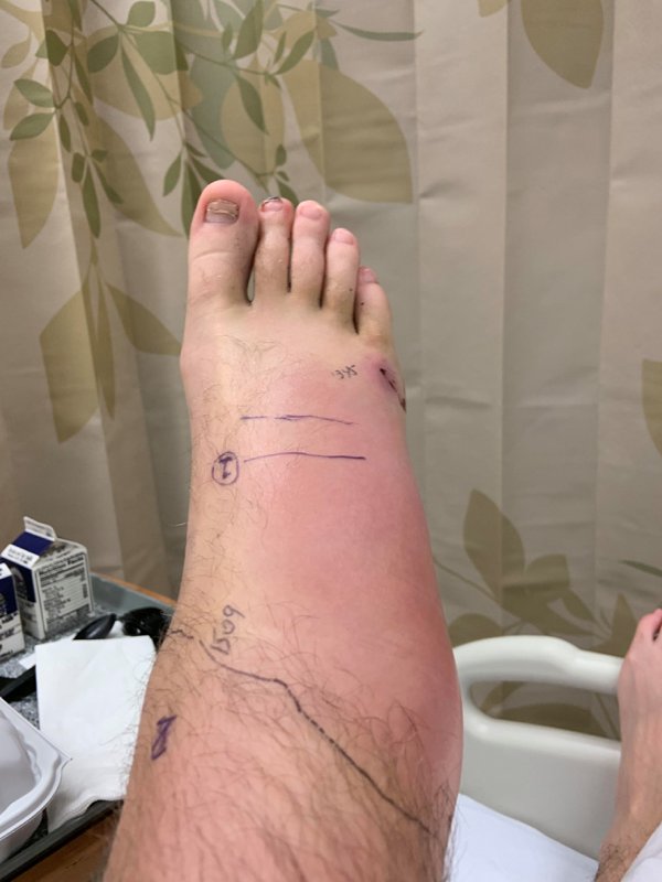 Rattlesnake bite ankle swollen up huge