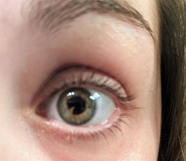 close up of woman's eye with weird defect in her iris