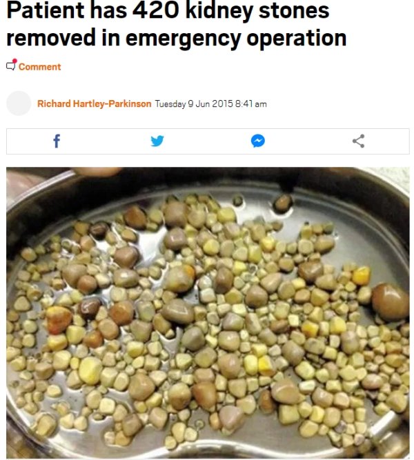 kidney stones - Patient has 420 kidney stones removed in emergency operation Comment Richard HartleyParkinson Tuesday f