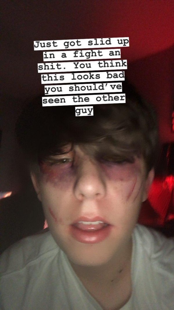 lip - Just got slid up in a fight an shit. You think this looks bad you should've seen the other guy