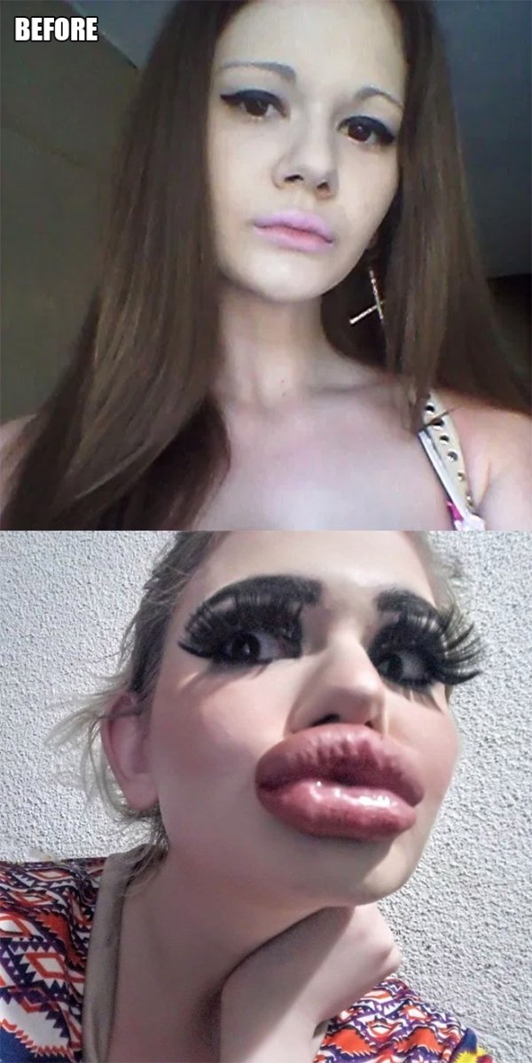 bulgarian lady big lips before and after
