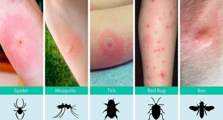 different bug bites - Spider Mosquito Tick Bed Bug Bee
