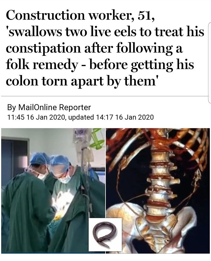 Construction worker, 51, 'swallows two live eels to treat his constipation after ing a folk remedy before getting his colon torn apart by them'