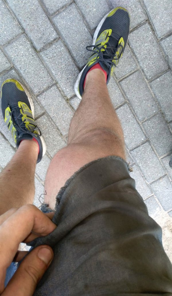 “Acquired myself a third knee after a wasp sting.”