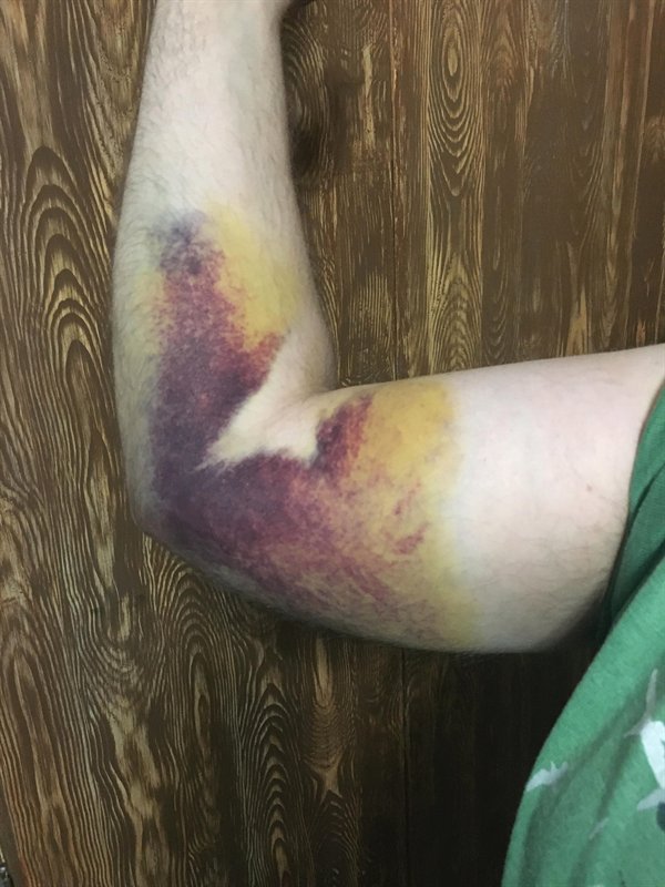 “Here’s my torn bicep tendon after throwing a frisbee so hard that it never landed..”