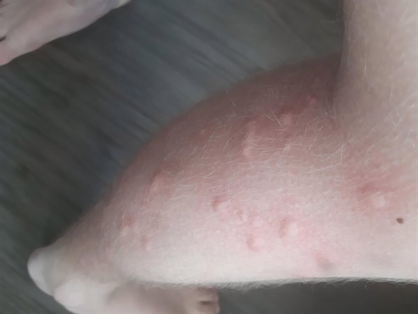 “Around 40 mosquito bites on just 1 leg.”
