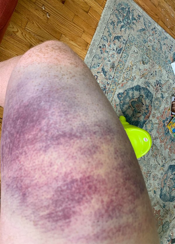“Spent the last two months exercising, eating well, getting in shape. Sunday was my first organized soccer game in ten years. 35 minutes in and I partially tore my quad. Shit.”