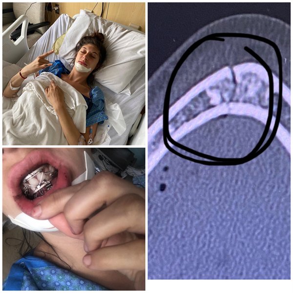 “Flipped over the 4 wheeler while camping the other night and broke my jaw in 2 places. Mouth is wired shut and stuck on an all liquid diet for next month. Always wear a helmet!!”