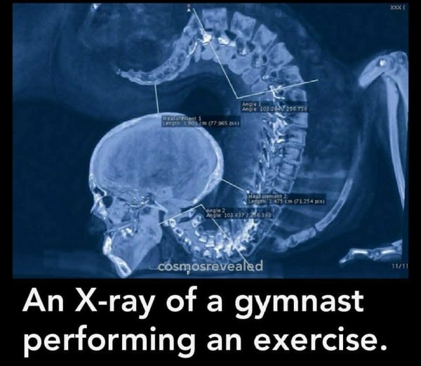 contortionist x ray - Xxx Angol ma 1013 Sete Wortel Lotho.Com 07965 Mement Les 2475 cm 1.254 Angle 2 cosmosrevealed 1111 An Xray of a gymnast performing an exercise.