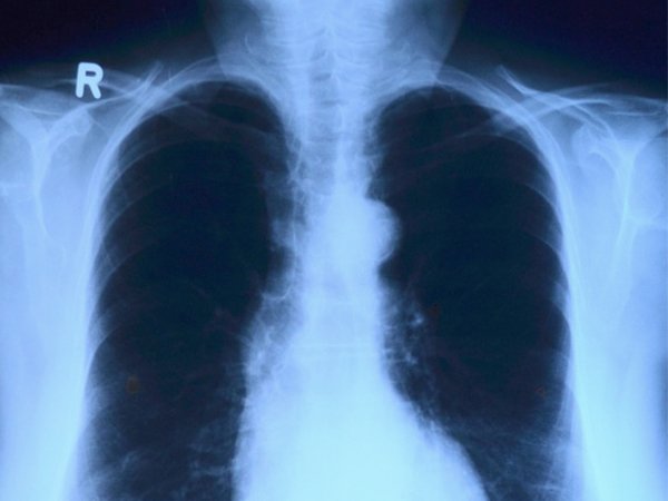 lung infection treatment - R