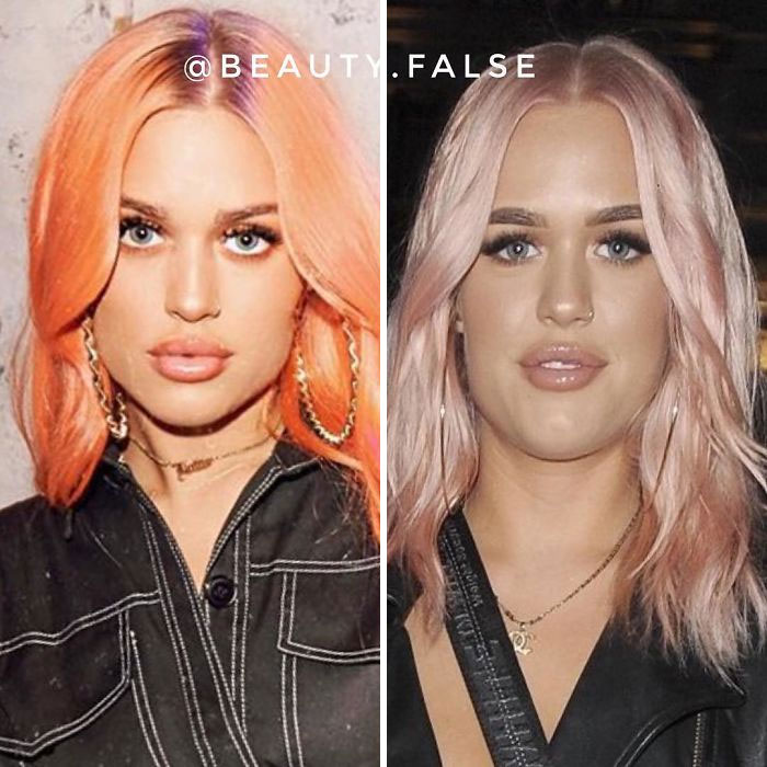 lottie tomlinson lip filler - @ Beauty.False waigen e