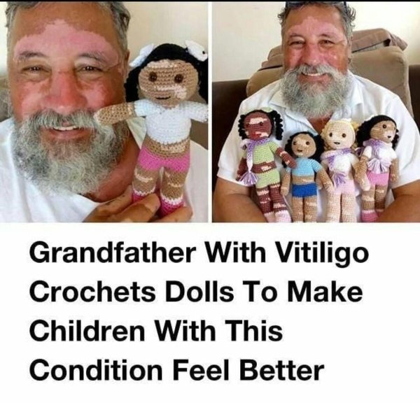 Grandfather With Vitiligo Crochets Dolls To Make Children With This Condition Feel Better