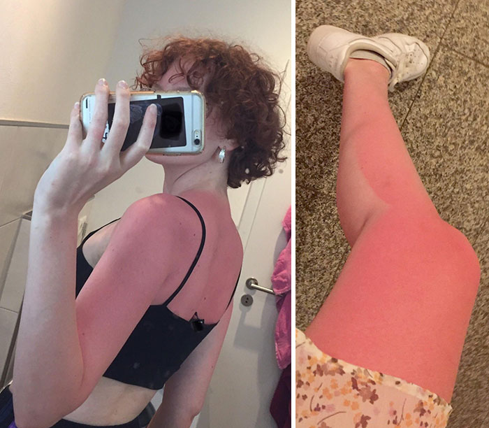 33 People Who Got Seriously Sunburned.